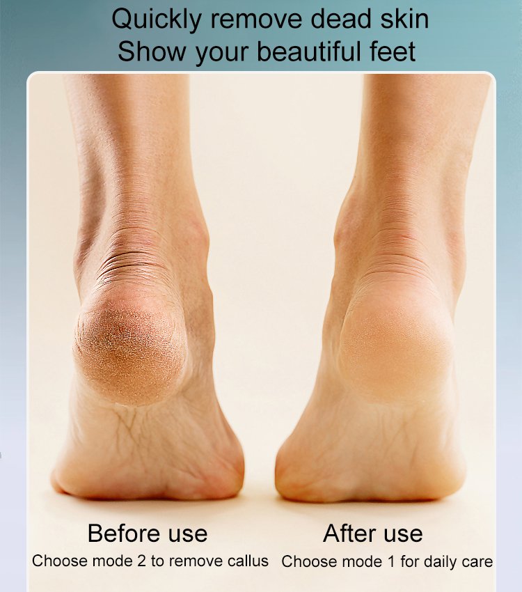 🔥Hot Sale - 50% OFF💕Rechargeable Electric Foot Callus Remover