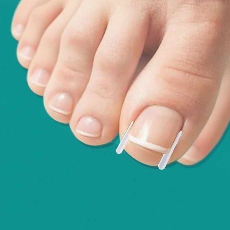 đ„LIMITED OFFERđ„Ingrown Toenail Treatment Corrector Set