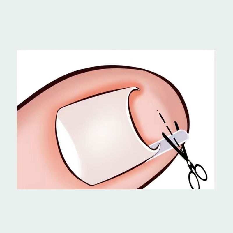 đ„LIMITED OFFERđ„Ingrown Toenail Treatment Corrector Set
