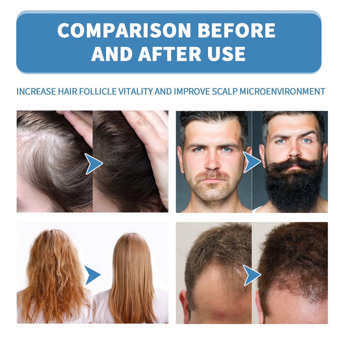 🌿EAST MOON Minoxi Roll-On Hair Treatment|Buy 1  Get 1 Free🔥